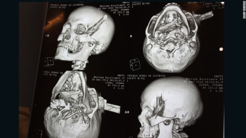 男子與人爭吵被刀刺穿頭骨送醫(yī)后奇跡存活(圖)